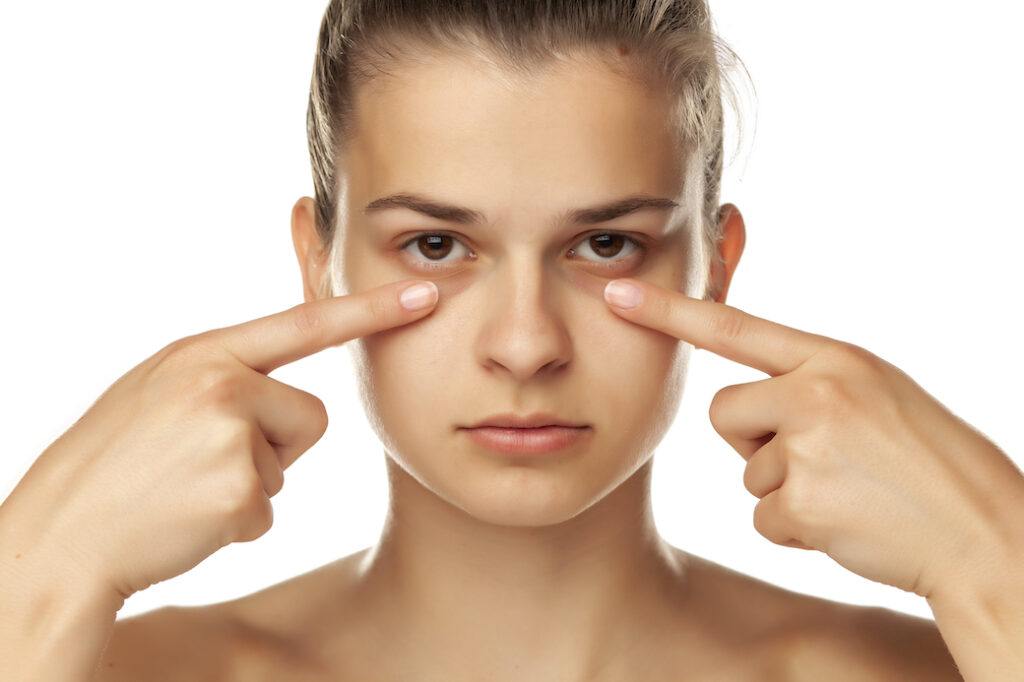 Causes And Treatment Of Dark Circles