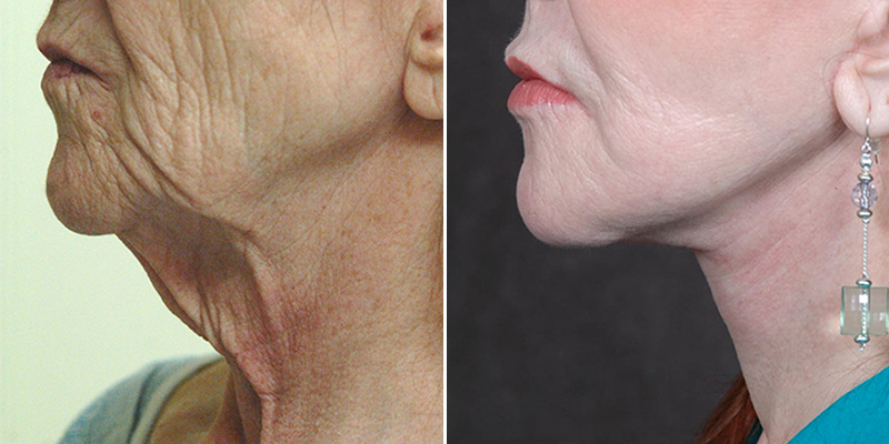 What You Didn’t Know About Neck Lifts