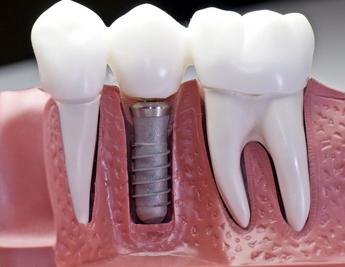 Dental Implant Restorations: Fixed or Removable?