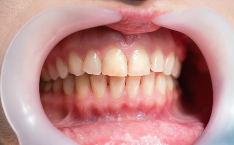 5 Different Types of Periodontal Diseases