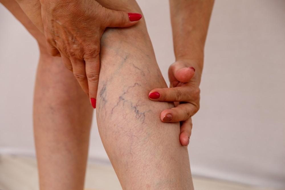 A guide to non-surgical treatments for vein conditions