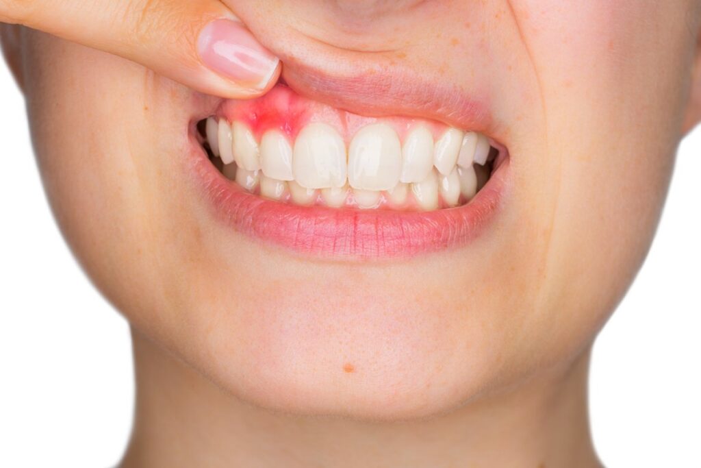 Symptoms and Treatment for Gum Disease in Parkland, Florida