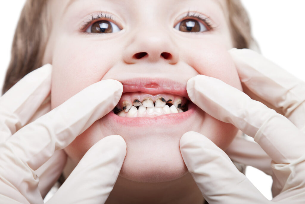 Braces’ Effect on Tooth Decay