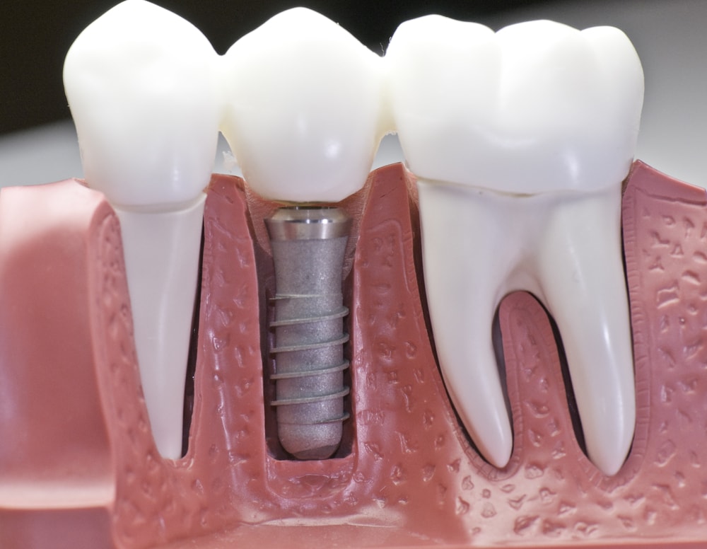 Benefits of Choosing Dental Implants Over A Traditional Fixed Bridge