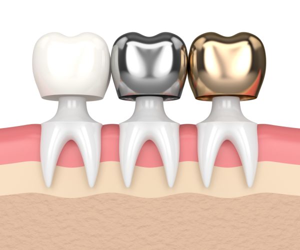 How to Know It May be Time to Replace Your Dental Crowns in Midlothian, VA