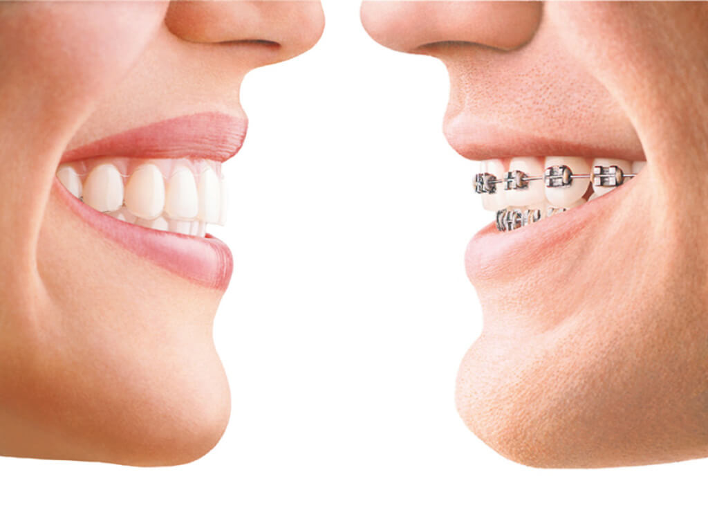 How to Know if You Have Chosen The Best Dentist For Invisalign Treatment?