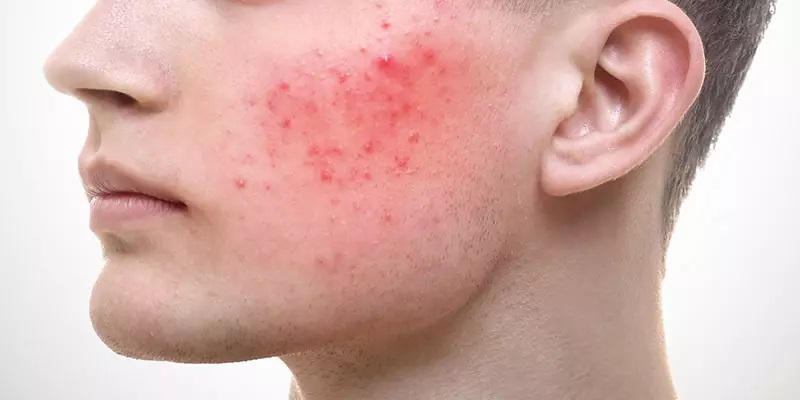 Rosacea: Causes and Treatments