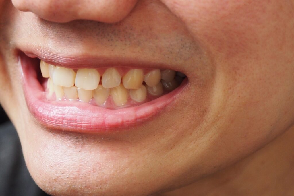 Everything You Need To Know About Tooth Stains