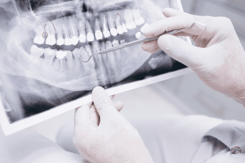 Why are Dental X-Rays Important?