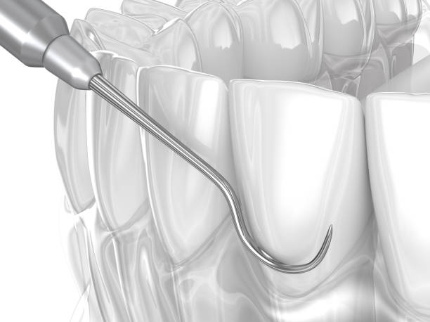 Periodontal Scaling & Root Planing: A Guide for Patients