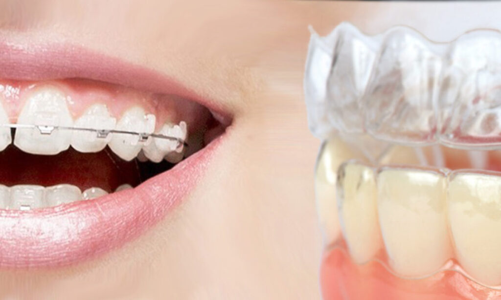 Why are Clear Aligners Better Than Traditional Braces?