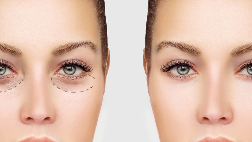 Eyebag Removal: A Fresh Look at Facial Aesthetic Procedures
