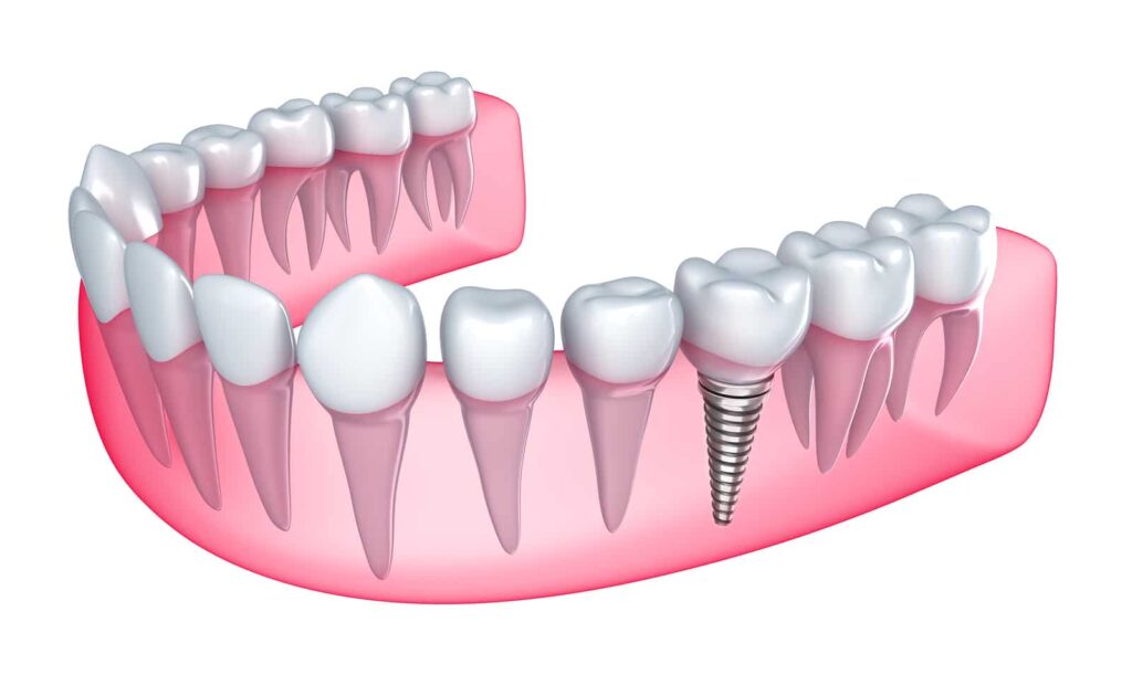 Are Dental Implants the Ultimate Replacement for Missing Teeth?