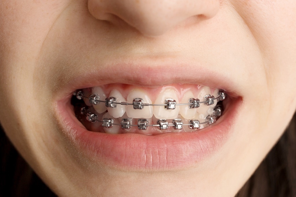 Must-Know Tips to Avoid Mouth-Sores with Braces