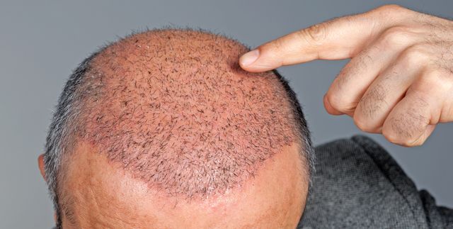 How To Know About The Most Appropriate Technique For Hair Restoration?