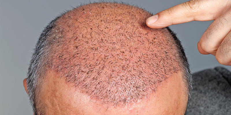 Why To Choose Hair Transplant For Permanent Hair Loss Solution?