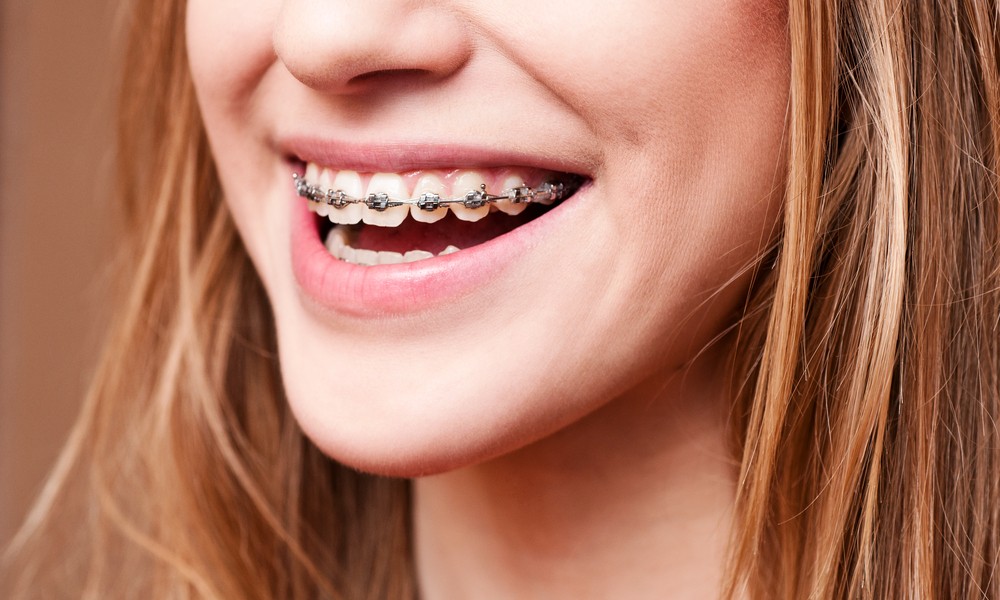 How to Care for Your Teeth if You Have Braces
