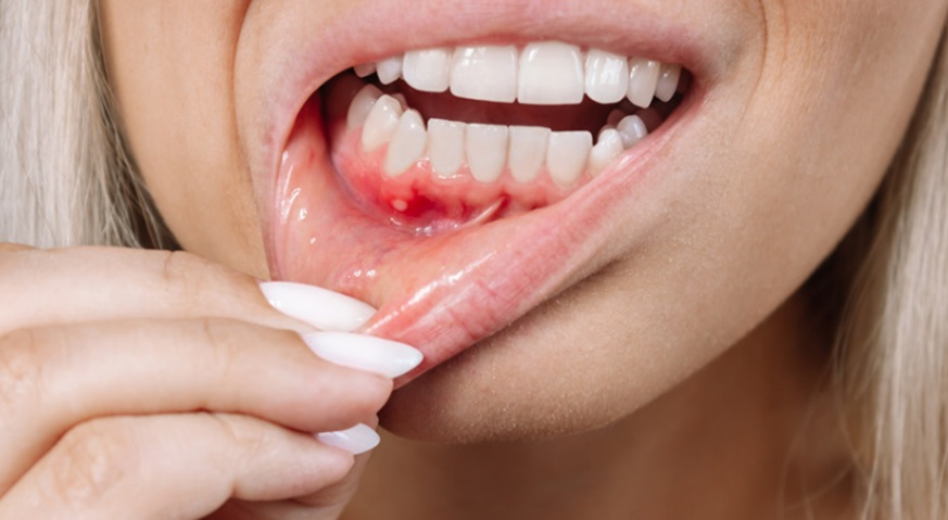 Gum Disease Affects