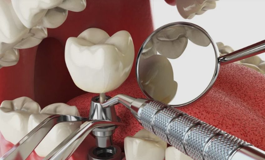 Reasons Dental Implants