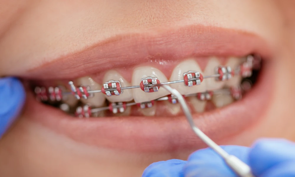Why Bite Alignment Matters More Than Appearance: The Hidden Benefits of Orthodontic Treatment
